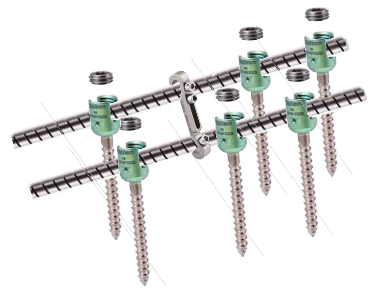 Система для транспедикулярної фіксації хребта з гнучкими стрижнями Flex (6 гвинтів) Medical Concept